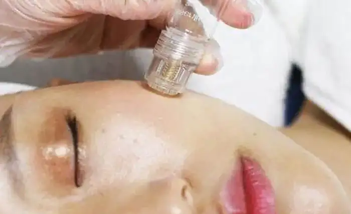 Micro-Infusion System