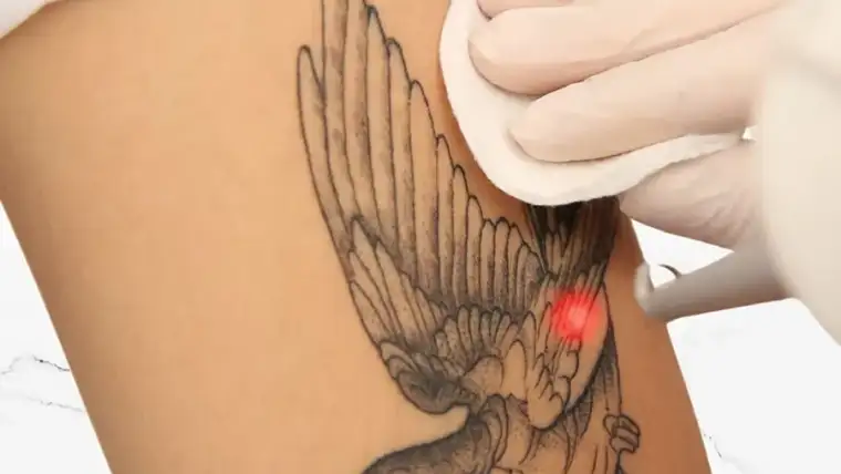 Laser Tattoo Removal