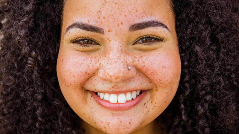 Age spots and Freckles