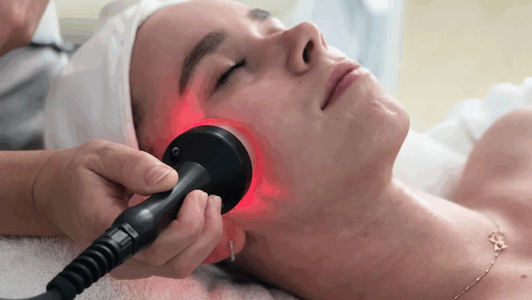 Microdermabrasion+ Radiofrequency